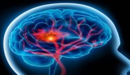 أعراض السكتة الدماغية وأسبابها .. و التشخيص و كيفية العلاج