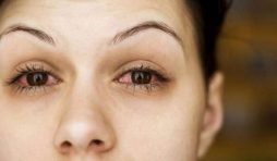 اعراض حساسية العين
