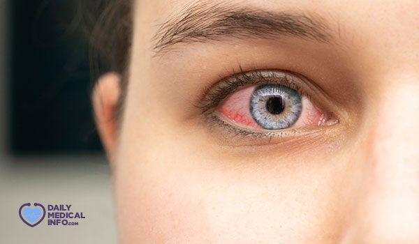 التهاب الملتحمة (العين الوردية)