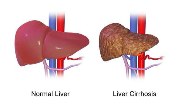 تشمع الكبد Liver cirrhosis