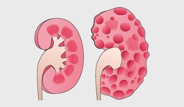 مرض تكيس الكلى Polycystic kidney disease