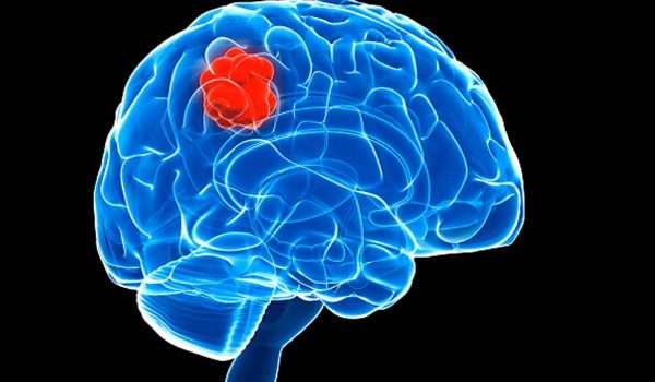 أورام المخ Brain tumors