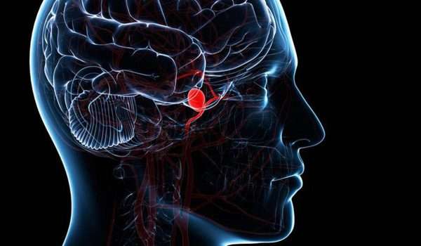 تمدد الأوعية الدموية في الدماغ
