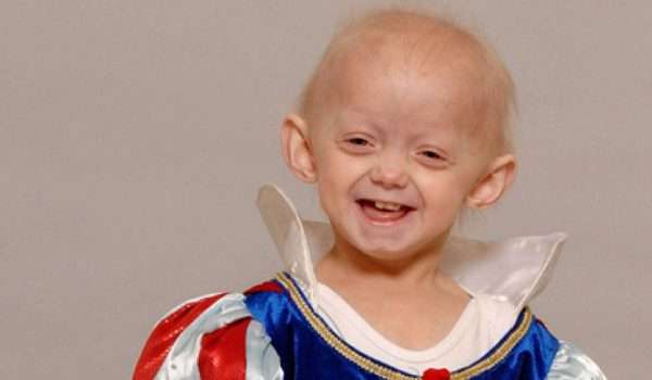 الشيخوخة المبكرة progeria syndrome