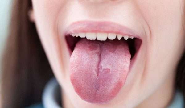 متلازمة الفم الحارق Burning mouth syndrome