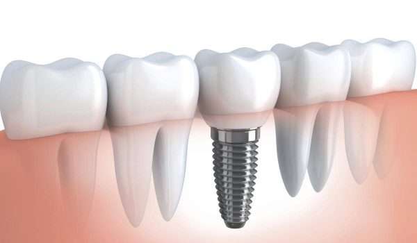 زراعة الأسنان أحد التقنيات الحديثة التي تعتبر بديل ممتاز لجذور الأسنان الطبيعية، لذا تعرف من هنا على مميزات وعيوب زراعة الأسنان وأنواعها 