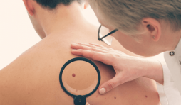 دراسة تكشف العلاقة بين “الوحمات” وسرطان الجلد