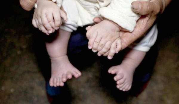 حالة طبية نادرة.. طفل لديه 31 إصبع في يديه وقدميه !