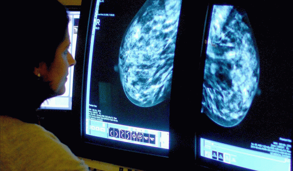 تشخيص سرطان الثدي