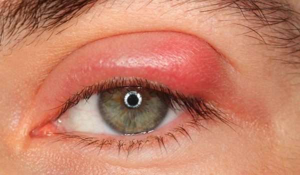 الكيس الدهني في العين وعلاجه بالطرق الطبيعية والجراحية