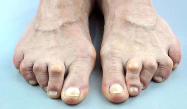 تشوهات اصابع القدم : اصبع المطرقة وطرق علاجه