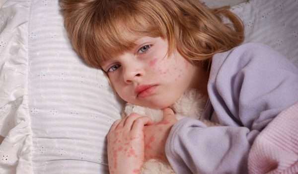 حساسية الجلد عند الاطفال بالصور .. أنواعها وطرق علاجها