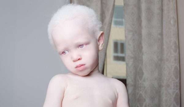 المهق Albinism