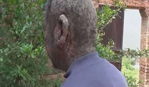 الرجل الشجرة .. رجل صيني يعاني من مرض جلدي غريب يعزله عن الناس!