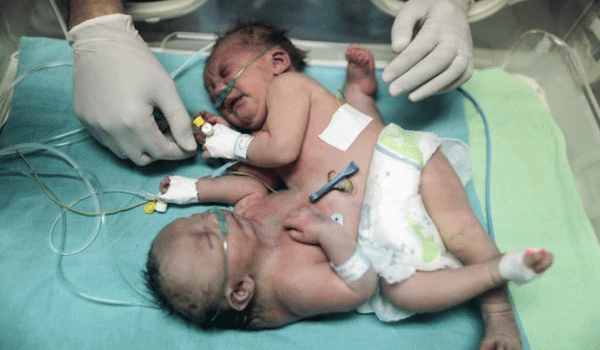 بالصور .. ولادة توأم ملتصق في غزة بحالة نادرة