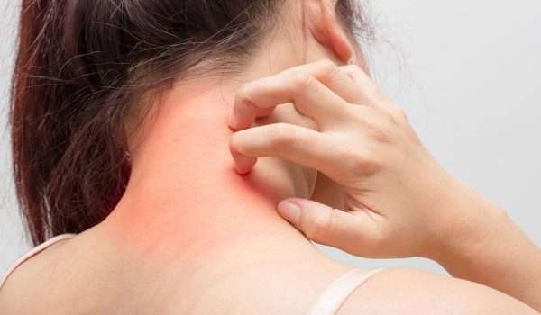التهاب الجلد التماسي Contact dermatitis