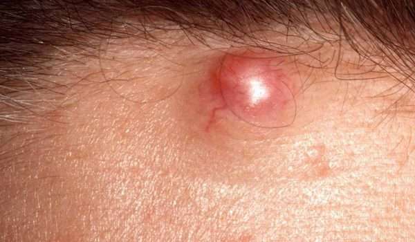 خراج الجلد Epidermoid cysts