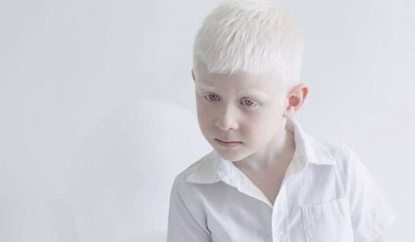 مرض المهق Albinism