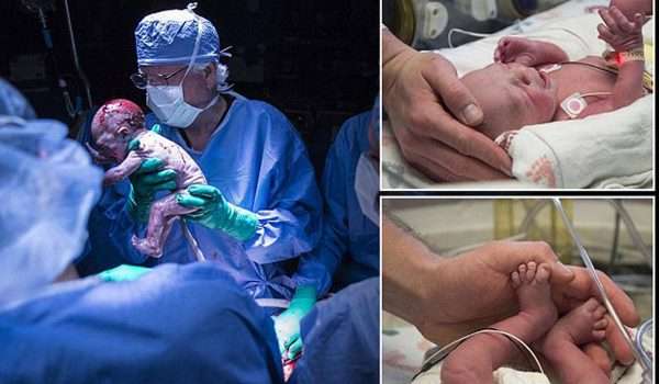 ولادة أول طفل من رحم مزروع في سبق طبي في أمريكا