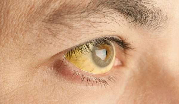 اسباب اصفرار العين وما علاقة التهاب الكبد بحدوثه ؟