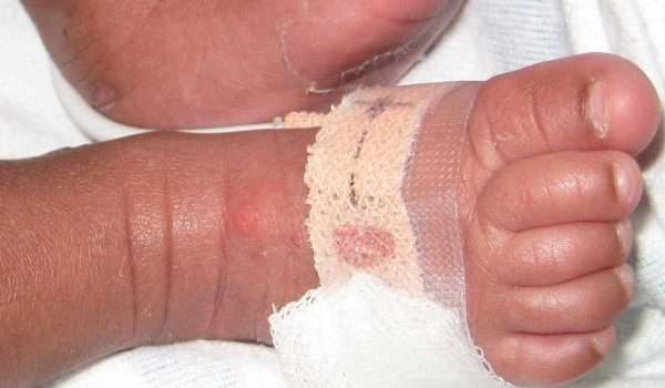 مرض الفقاع الجلدي عند الاطفال