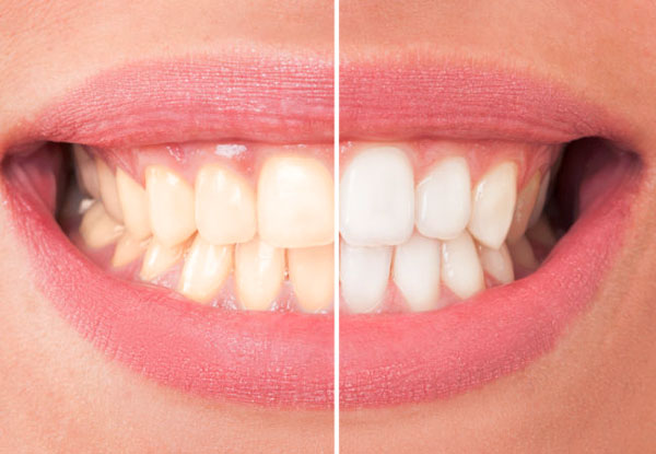 نتائج تبييض الاسنان بالليزر قبل وبعد