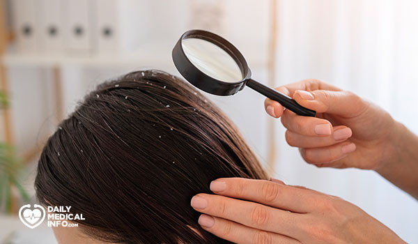 علاج قشرة الشعر الدهني (علاج القشرة الدهنية)