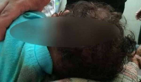 أطباء مصريون يستخرجون سيخ حديد اخترق رأس رضيع.. ومازال حيا يرزق!