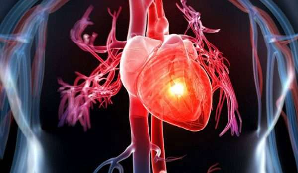 نقص التروية القلبية Myocardial Ischemia