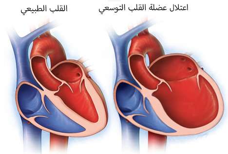 اعتلال عضلة القلب التوسعي