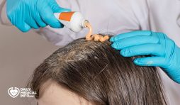 علاج صدفية الشعر