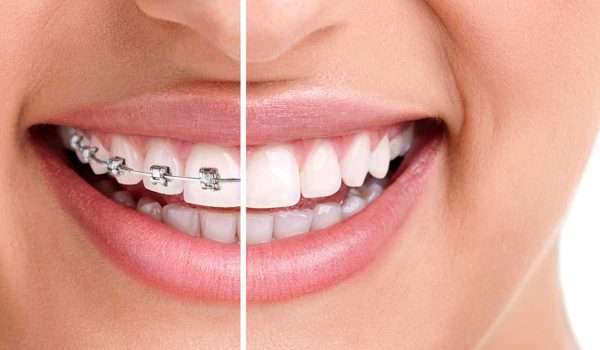 تقويم الأسنان Dental braces