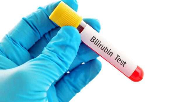تحليل البيليروبين Bilirubin test