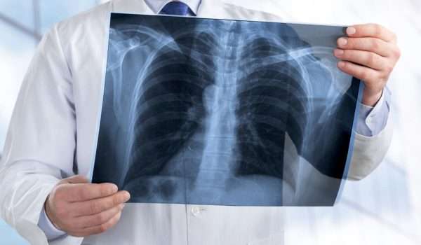 تصوير الصدر بالأشعة السينية Chest X-rays