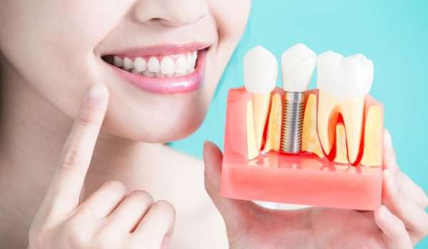 جراحة زراعة الأسنان