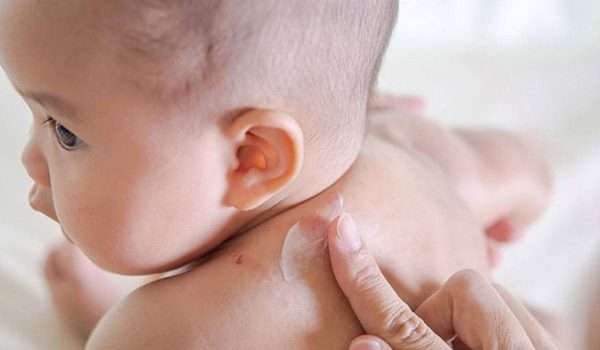 طفح جلدي عند الاطفال بعد الحرارة