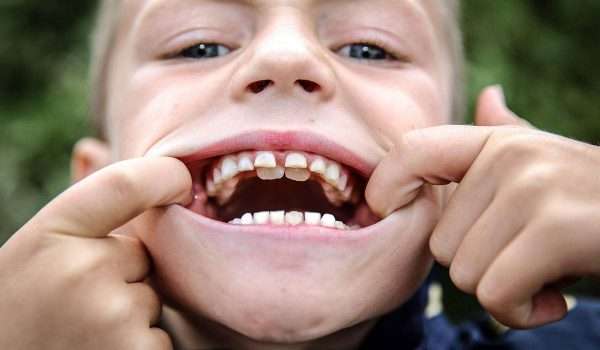 ظهور الاسنان الدائمة خلف اللبنية أو اسنان القرش لدى الاطفال .. ما هي؟
