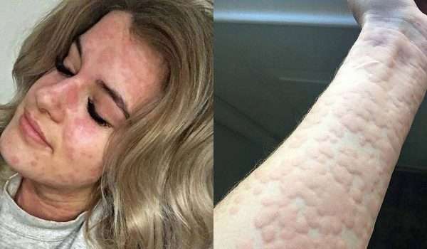 ” حساسية البرد الجلدية ” حالة نادرة تجعل جلد هذه الفتاة كخلية النحل!