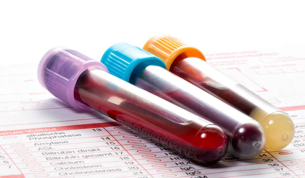 نتائج تحليل الدم قد تكشف عن الزهايمر قبل ظهور الأعراض!