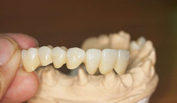 جسر الاسنان الزيركون من أفضل الخيارات لجسور الأسنان