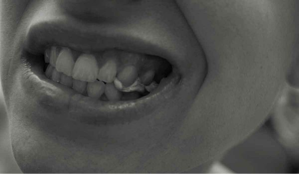 تقوية الاسنان الضعيفة
