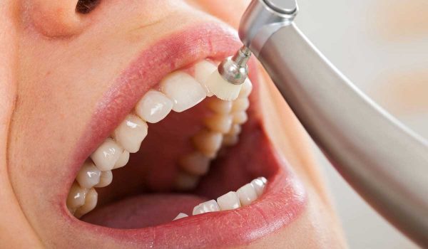 تلميع الاسنان .. أنواعه ومميزاته وعيوبه واحتياطات مهمة