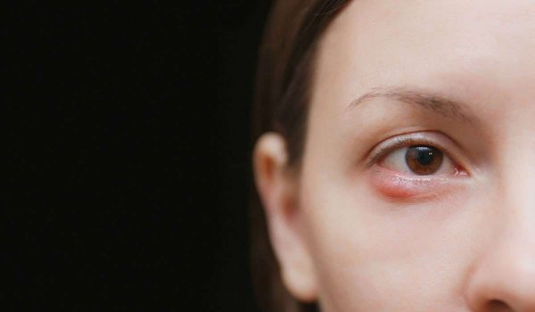 علاج التهاب جفن العين