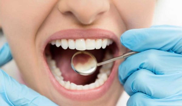 علاج تسوس الاسنان الامامية