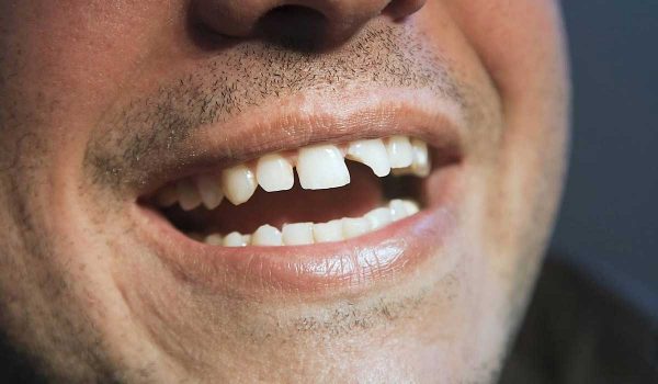علاج تكسر الاسنان بالطرق المختلفة.. وكيف يمكن الوقاية منه؟