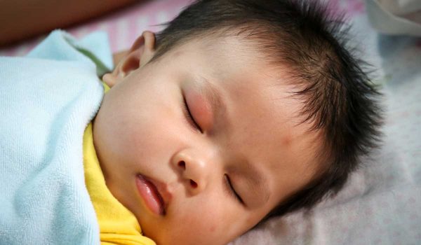 احمرار جفن العين عند الاطفال الرضع
