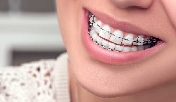 انواع تقويم الاسنان المختلفة .. وهل التقويم مؤلم للأسنان؟