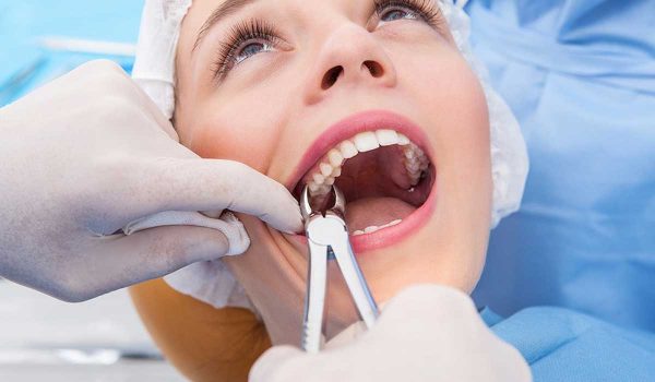 خلع الاسنان والضروس: كل ما يهمك عنه