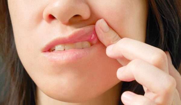 علاج التهاب الفم