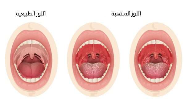 أعراض التهاب اللوزتين